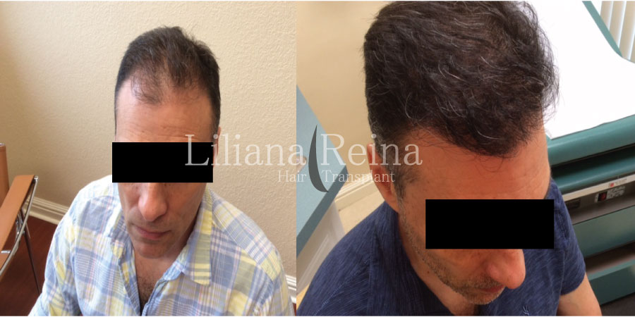 fue metodo de implante capilar