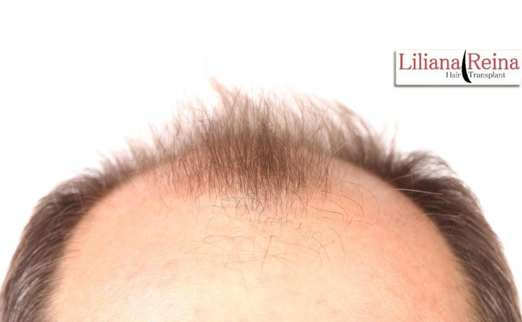 Límite de edad en el trasplante capilar