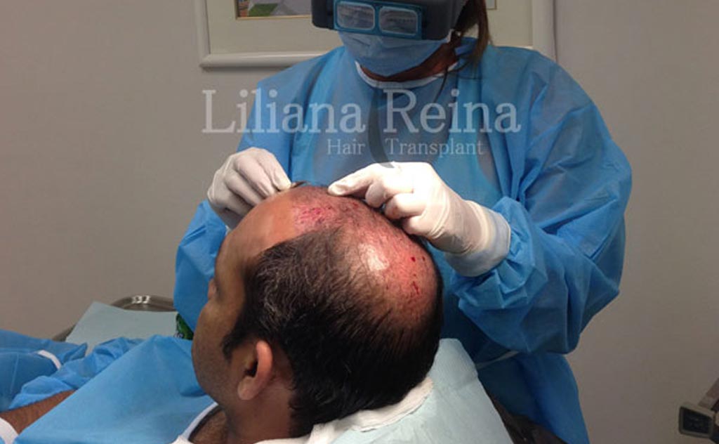 Cirugía Capilar