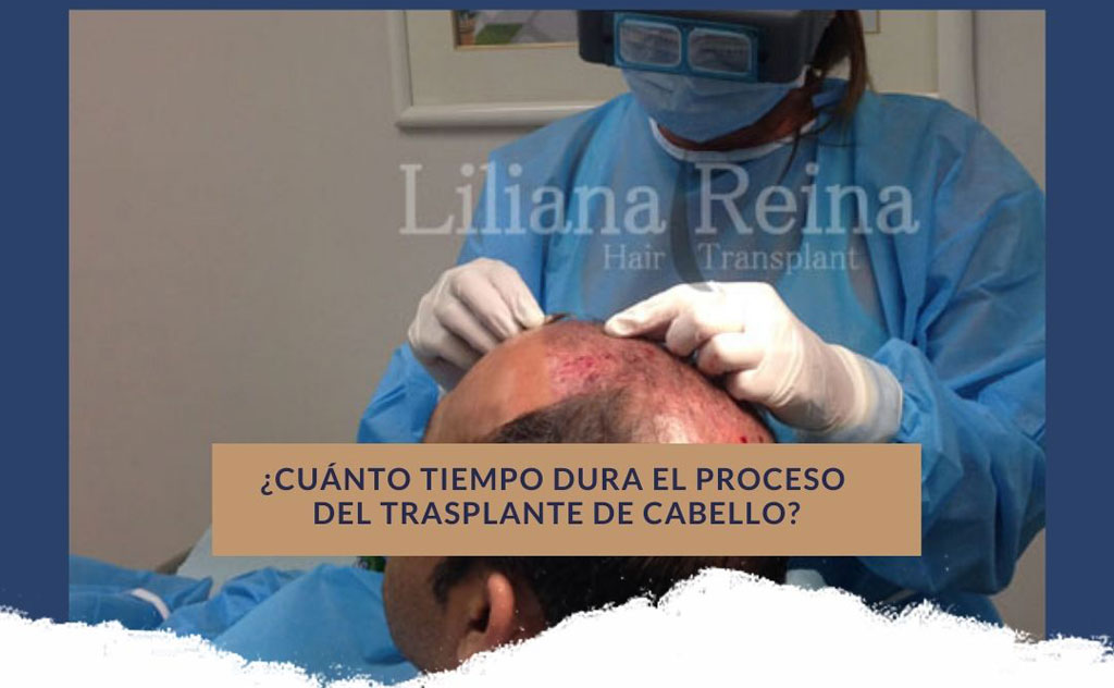 Trasplante de cabello