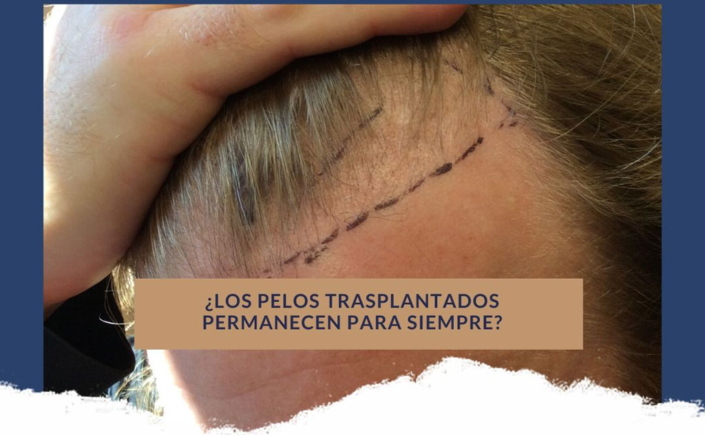 Pelos Trasplantados